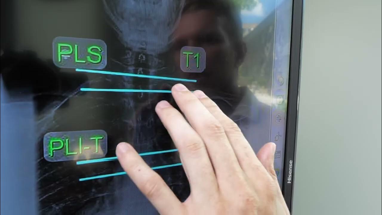 have-you-ever-wondered-what-the-marks-on-your-x-ray-mean-youtube