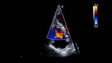 Ventricular Septal Rupture After Acute Myocardial Infarction