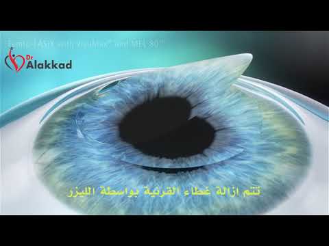 عملية الفيمتو ليزك لتصحيح النظر احدث تقنيات عمليات تصحيح النظر