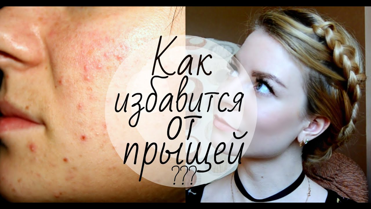 КАК ИЗБАВИТСЯ ОТ ПРЫЩЕЙ??? Уход за лицом в подростковом возрасте