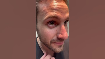 Look How Easy It Is To Remove A Scleral Lens