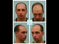 Dallas Hair Transplant Video Transformation