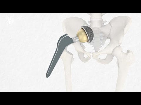 Implantation einer Hüftgelenk Endoprothese und Leben mit einem künstlichen Hüftgelenk - video from Thieme Compliance