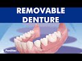 Removable partial denture 