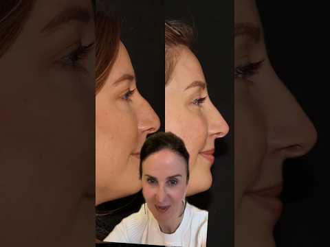 Liquid Rhinoplasty Before and After #liquidrhinoplasty #plasticsurgeon #beautytips