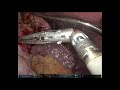 Robotic Da Vinci (Xi) Hiatal repair &amp; Nissen fundoplication for hiatus hernia with severe GERD