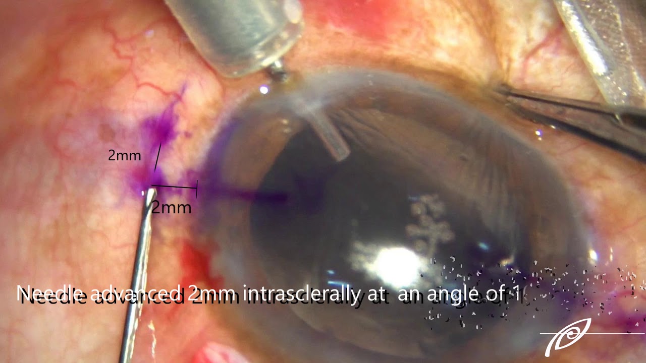 Intrascleral Sutureless Glueless Flanged IOL Fixation - YouTube