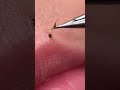 #BlackheadRemoval #PimplePopping #ASMRBlackhead 10