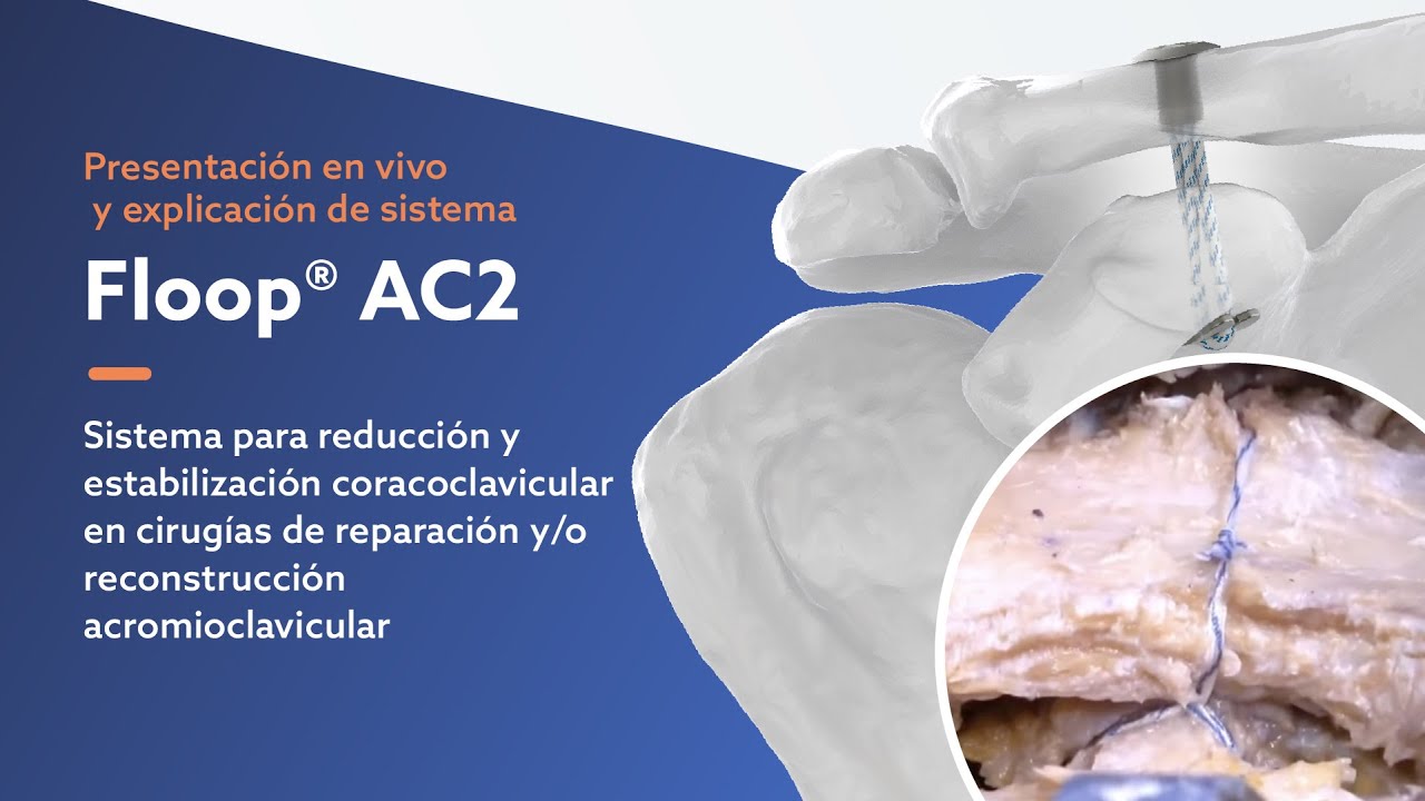 Floop® AC2 Acromioclavicular • Presentación de producto y técnica quirúrgica