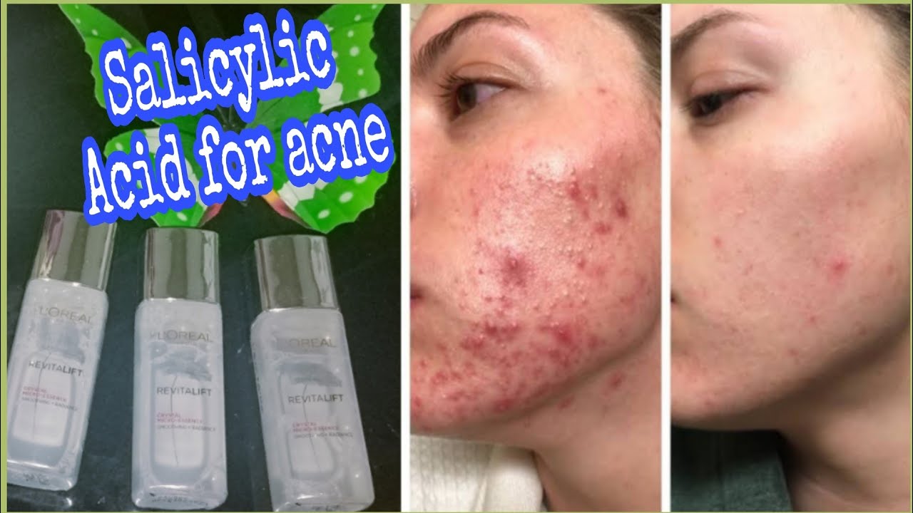 How to use salicylic acidL'Oreal Paris salicylic acid serum review