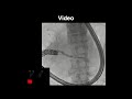 Endoscopic ultrasound-guided pancreaticoduodenostomy with a forward-viewing echoendoscope