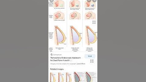 Nâng ngực dual plane