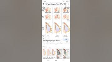 Nâng ngực dual plane