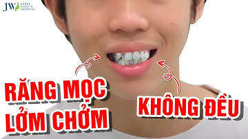 Niềng răng mắc cài giúp chàng trai RĂNG VẨU hoá SOÁI CA VẠN NGƯỜI MÊ