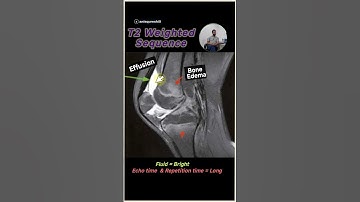 🦵 Knee MRI Simplified! #radiology #mri
