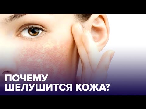 Почему КОЖА ШЕЛУШИТСЯ и как ее спасти?