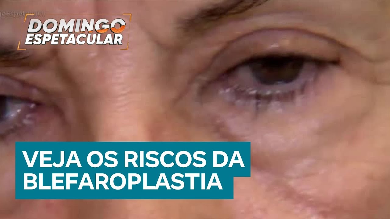 Blefaroplastia: conheça os riscos da cirurgia plástica mais realizada no mundo