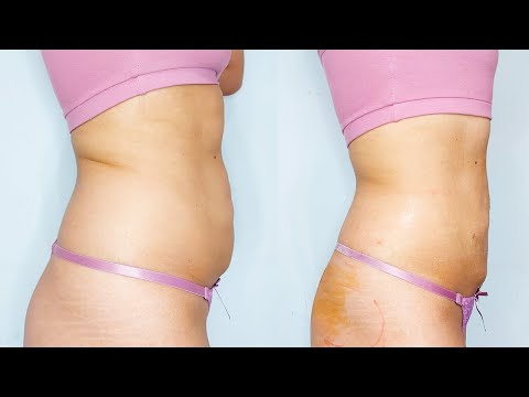 Video: ¿Duele la liposucción tumescente?