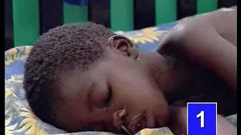 MSF Nutrition: Convulsions