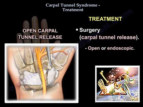 Dr. ebraheim’s educational animated video describes treatment of carpal tunnel syndrome. clinical picture syndrome pain, numbness, and pares...