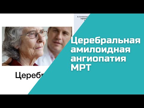 Церебральная амилоидная ангиопатия, МРТ признаки