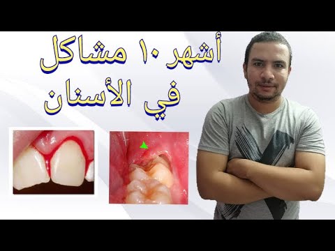 أشهر 10 مشاكل في الأسنان و اللثه و علاجها