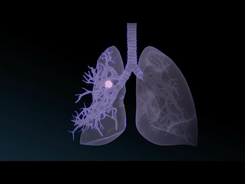 ANIMACIÓN: El nódulo pulmonar | AFP Animé