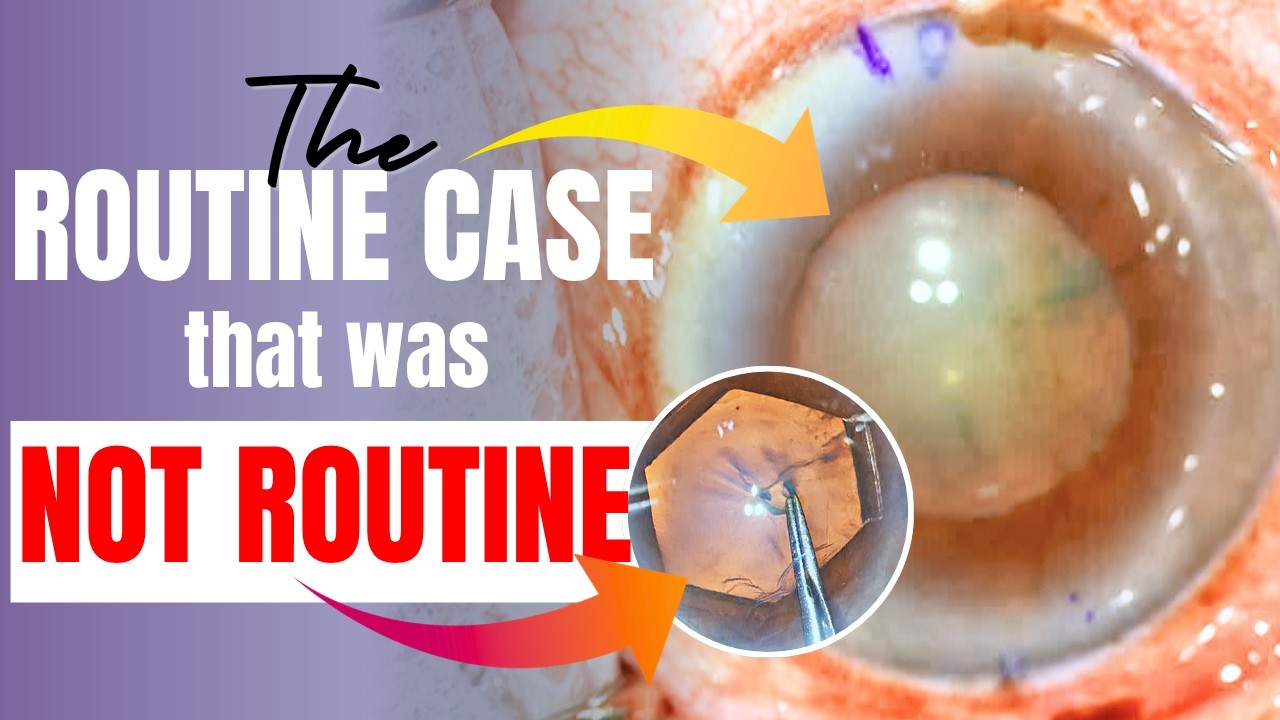 The Hidden Dangers of Apparent Routine in Cataract Surgery