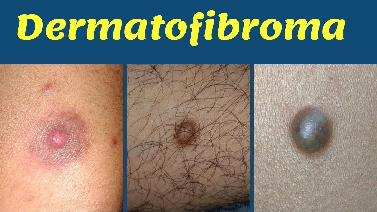 Dermatofibroma Treatment Hard Bump On Leg चमड़ी में सख़्त गाँठ का