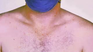 Typhoid fever | Wikipedia audio article