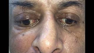Ocular bobbing - Abnormal eye movements #neurologist #neurologistindehradun 
