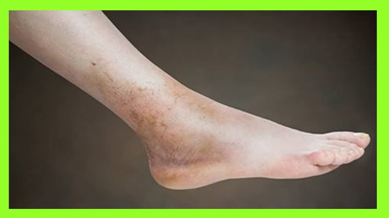 Si Sufres De Mala Circulaci�n Aqu� Est� La Soluci�n A Tu Problema En Solo 20 Minutos