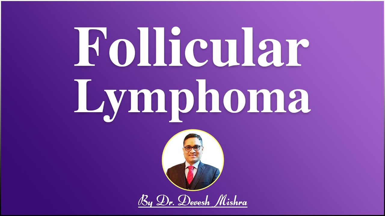 Follicular Lymphoma (INICET-Nov 2020 exam ) by Dr. Devesh Mishra.