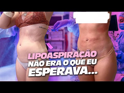 LIPOSUCTION: What NOBODY Tells You! 😰 | My Process, Pains and Recovery | Raka Minelli