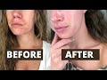 HOW I CLEARED MY ACNE FAST (MY SKIN JOURNEY 2020) | Lauren Peletier