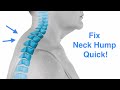 Fix Your Neck Hump | Buffalo Hump | Dowagers hump