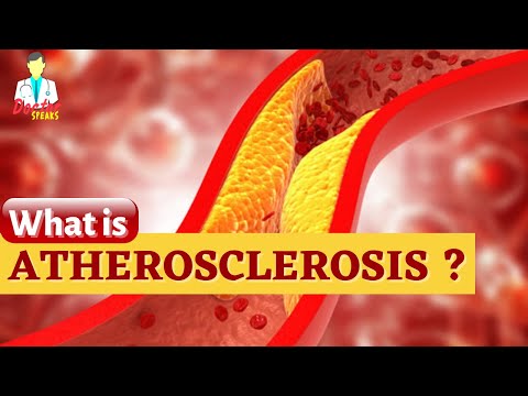 वीडियो: एथेरोस्क्लेरोसिस के लिए क्या छोटा है?