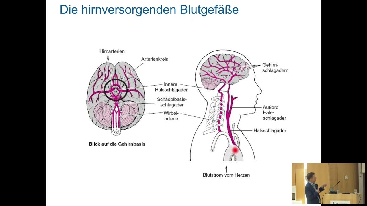 Zeitbomben oder Blindgänger Carotisstenosen, Kavernome,Aneurysmen