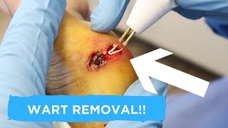 BURNING A WART OFF? **FULL PROCEDURE**