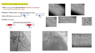 Bifurcation Left main part 2: case studies (2-stent techniques)