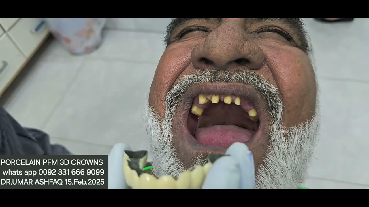 Porcelain dental covers teeth computerized laser cut  (PFM 3D)