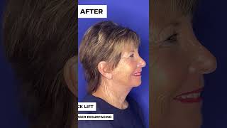 Facelift Before and After: DRAMATIC RESULTS! #shorts #faceliftsurgery