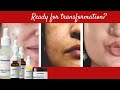 Be Minimalist Product Layering For Hyper pigmentation, Acne and Acne Scars: Skin Transformation