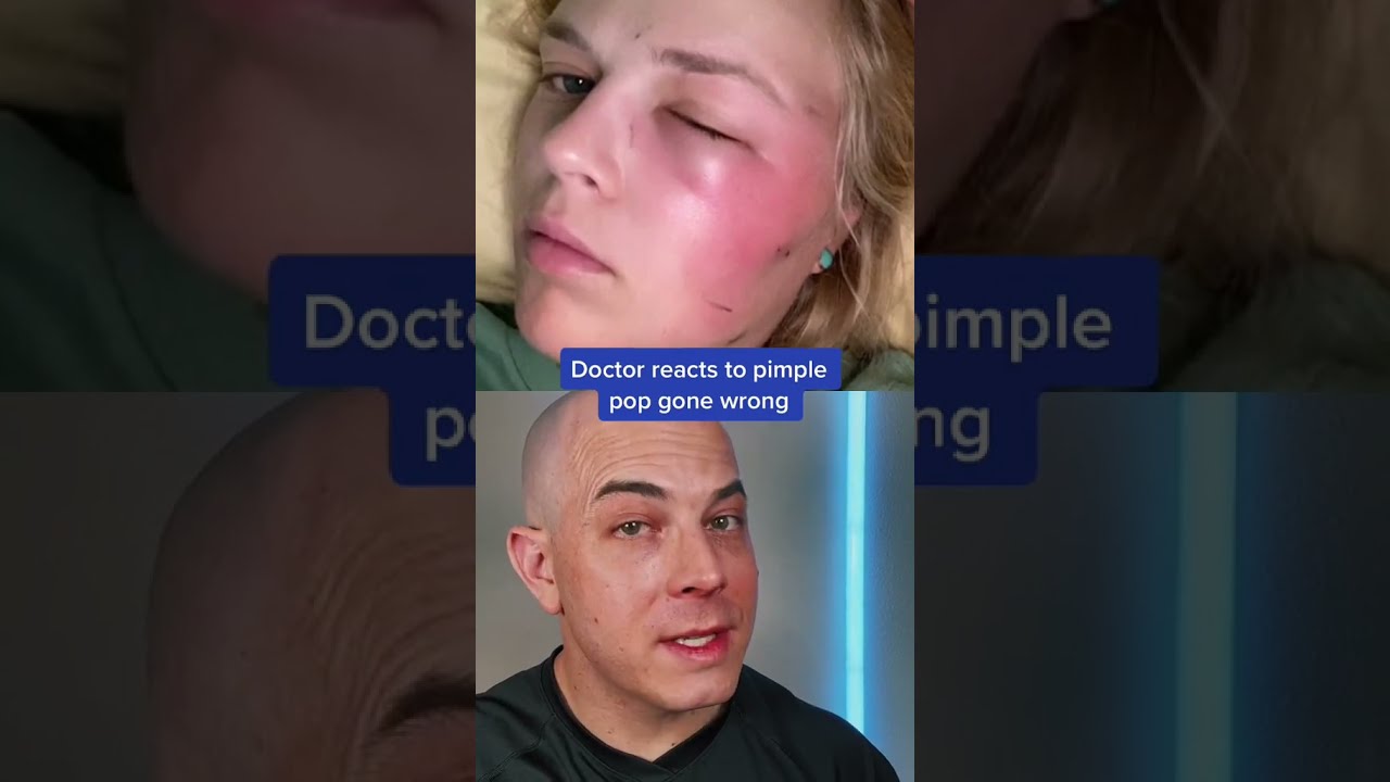 Doctor Reacts To The Risks Of Pimple Popping Pimplepopper Dermreacts