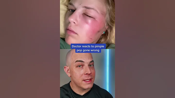 Doctor reacts to the risks of pimple popping! #pimple #pimplepopper #dermreacts