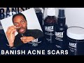 BANISH ACNE SCARS REVIEW | DOES IT WORK? THE HONEST TRUTH