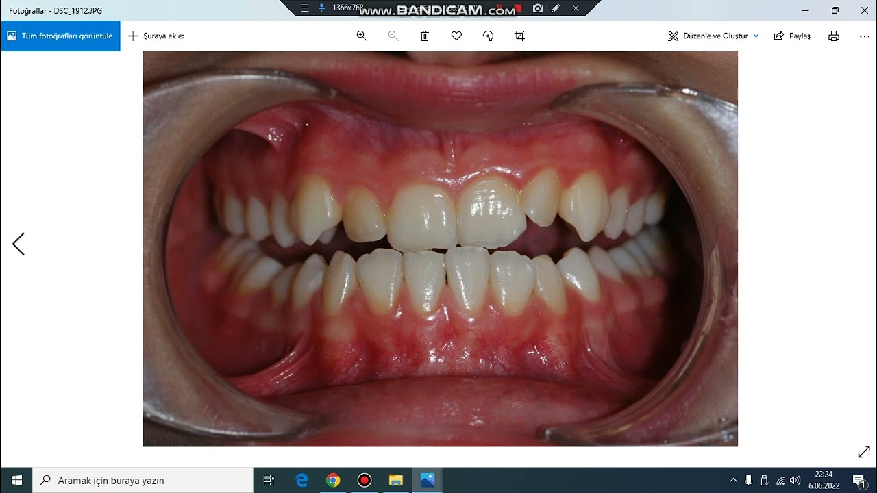 Alt çenesi ileride olanlar bu videoyu mutlaka izlesin. Çene ameliyatından kurtulabilirler.