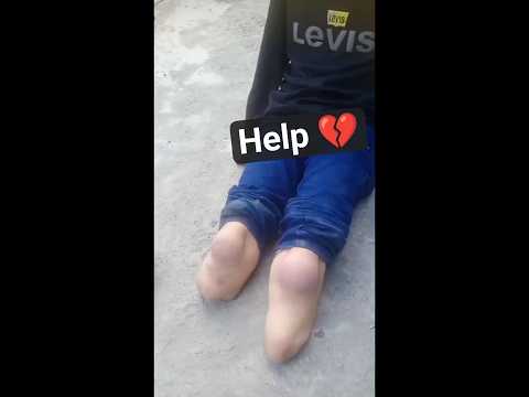 Little Boy Walking After Amputation 💔 Without Artificial Limbs | Painful Reality of Life' #nevergive