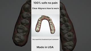 Clear Aligners #aligner #dentist#DRIshratMafruha #Denta #shorts #machine #dental