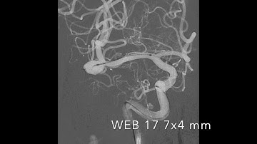 WEB 17 device for intracranial aneurysms